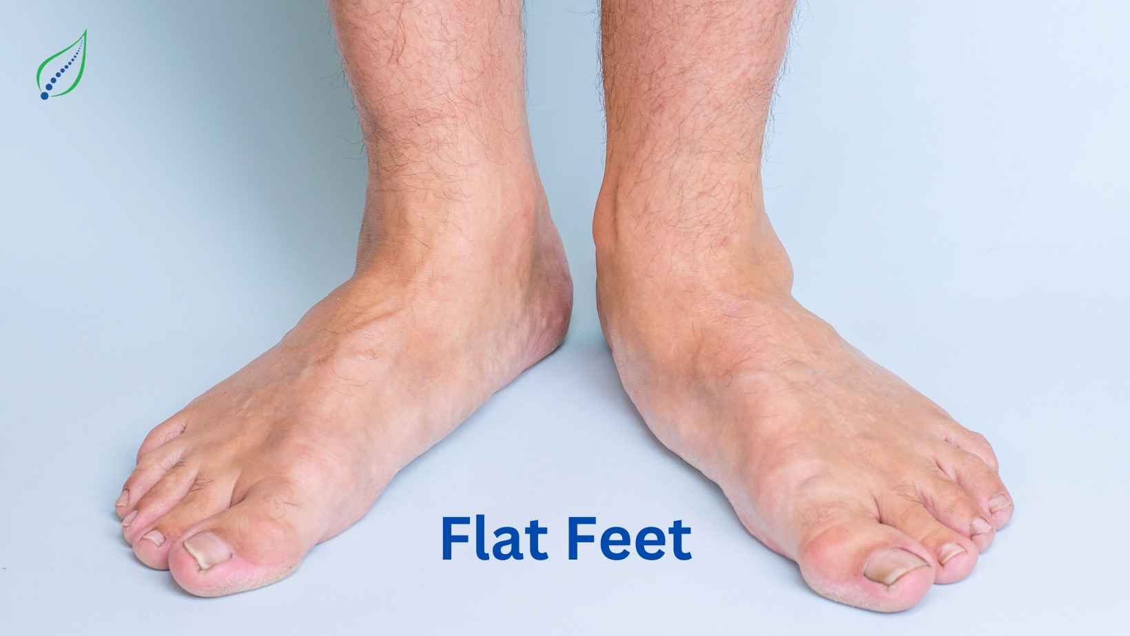 Flat Feet